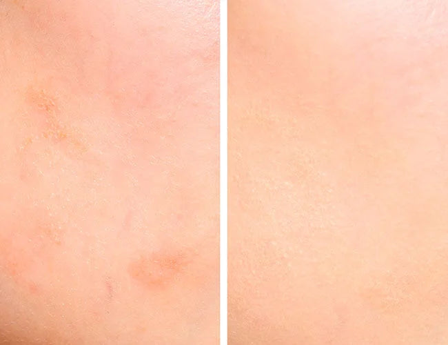 A comparison image is shown of how well redness can be concealed with a corrective pencil